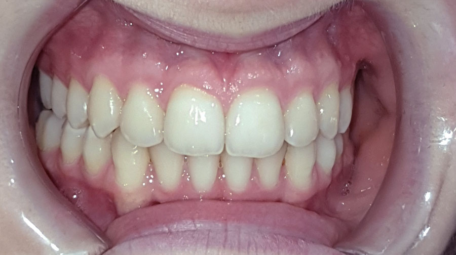 Ortodoncia invisible. Despuésdel tratamiento. Clínica Raga Valencia