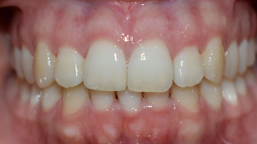 Caso de éxito de paciente con ortodoncia invisible. Después. Clínica Raga Valencia