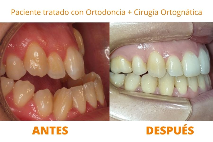 ortodoncia con cirugia ortognatica