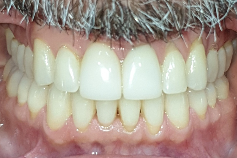 erosión dental