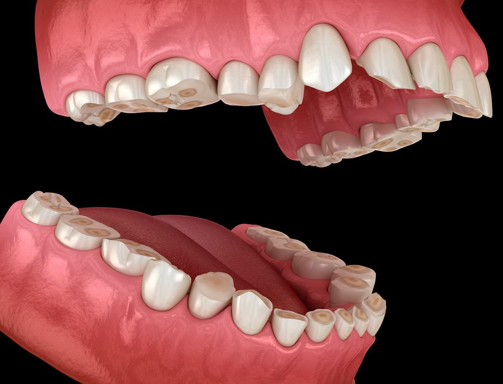 desgaste-dental