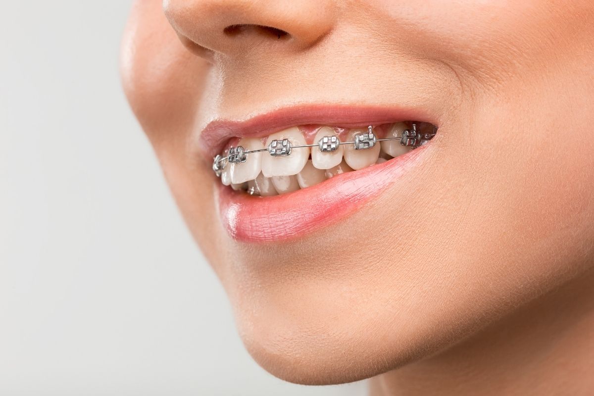 ortodoncia-ayuda-desgaste-dental
