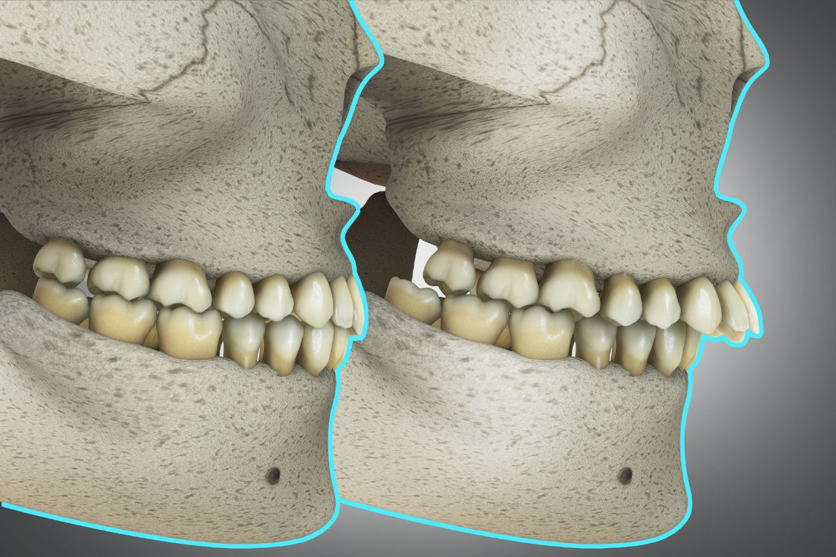 antes-y-despues-sobremordida