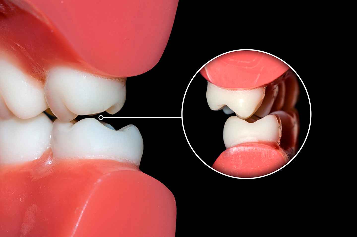consecuencias-maloclusion-dental