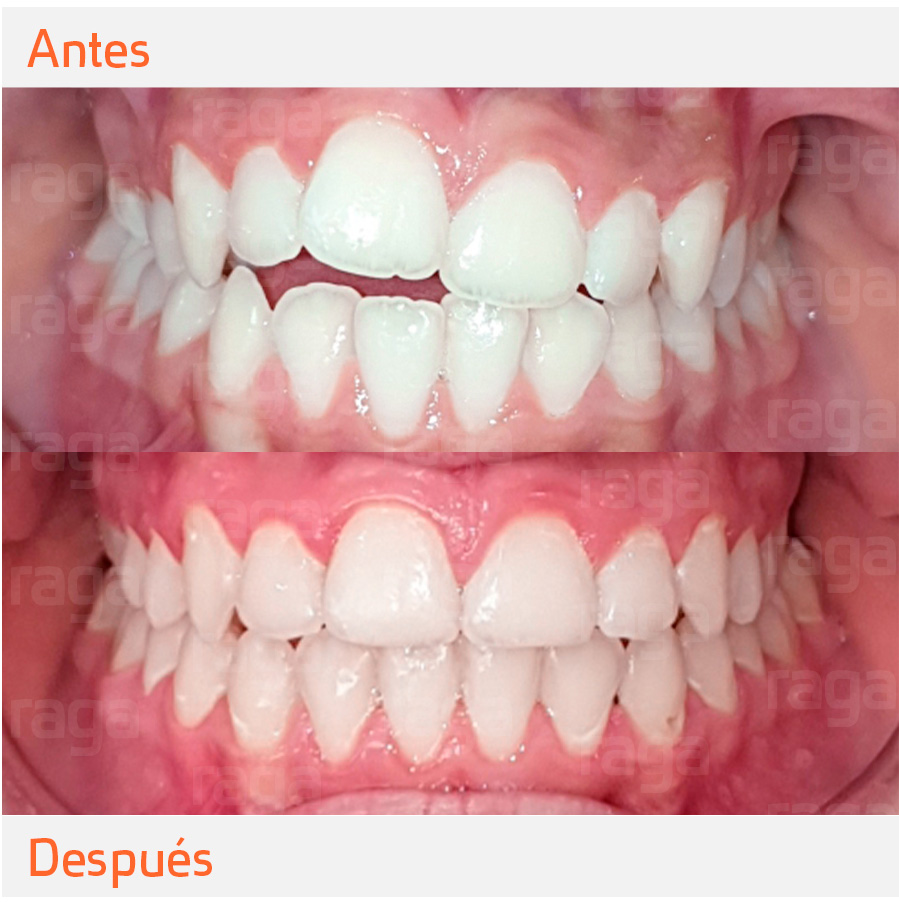 correccion-maloclusion-dental-raga