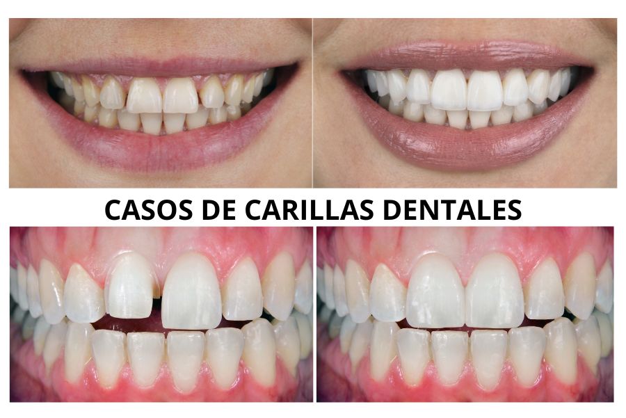 carillas dentales