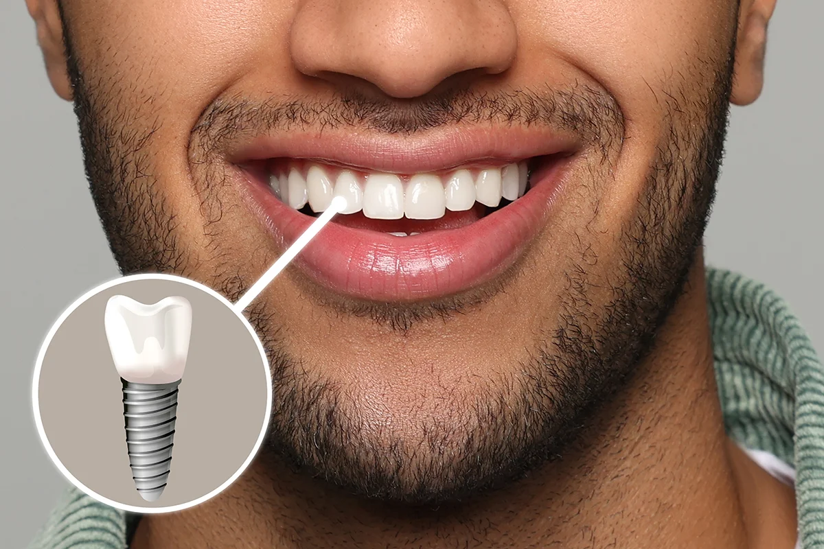 Implantes dentales