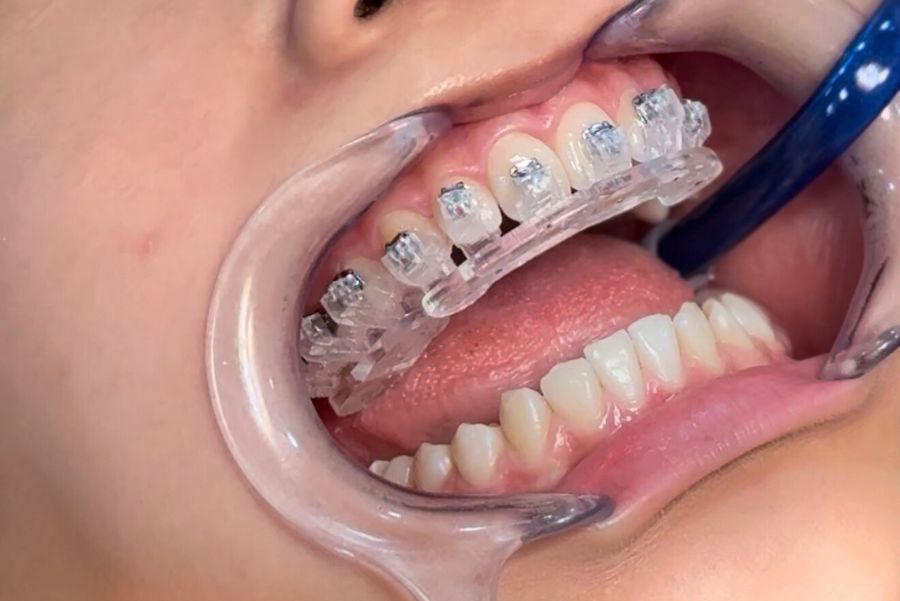 cementado indirecto de brackets