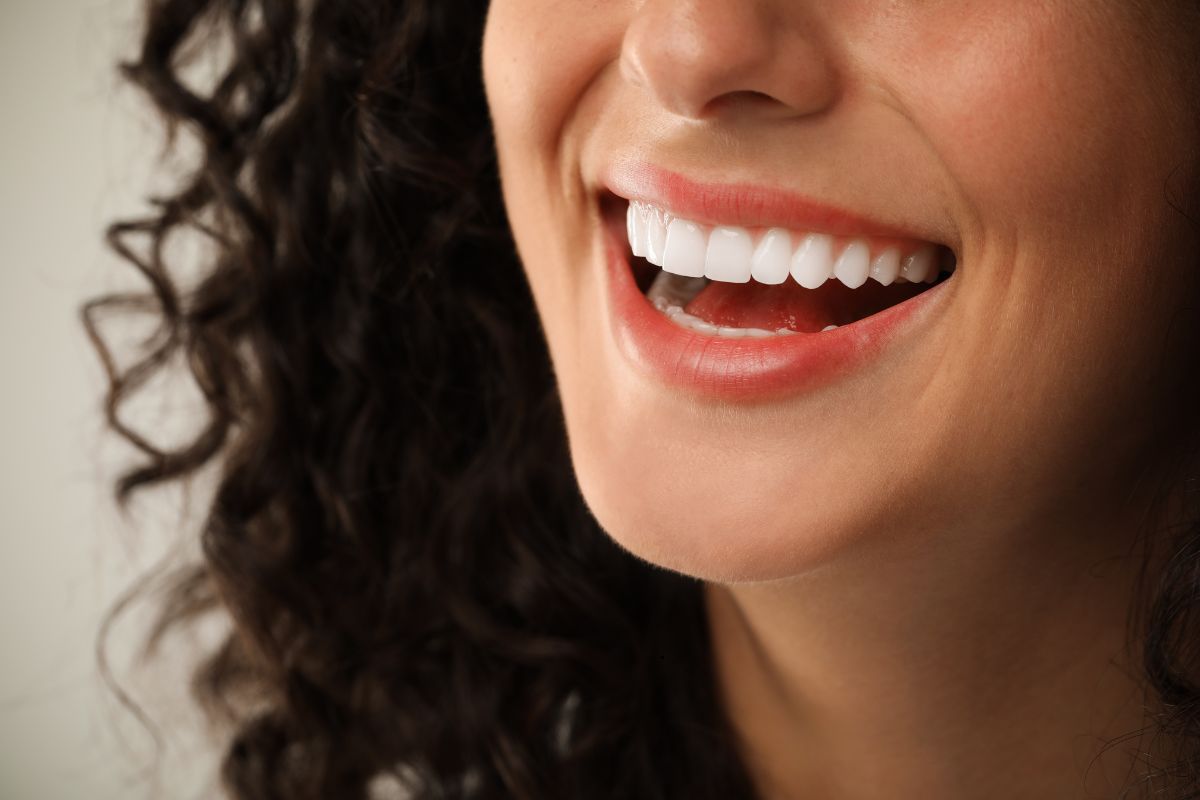 cuanto-duran-carillas-dentales