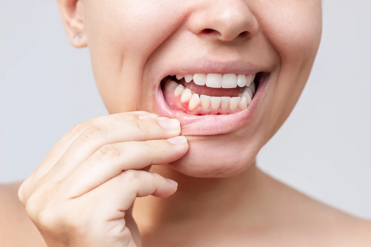 Periodoncia