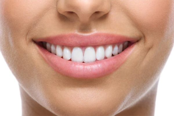 Carillas dentales