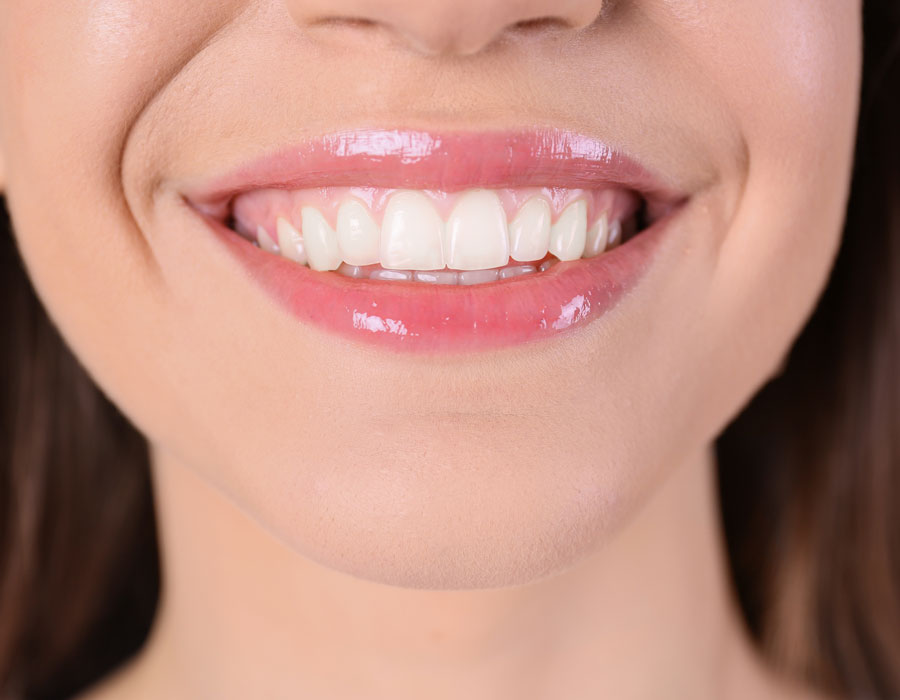 Contorneado estético dental