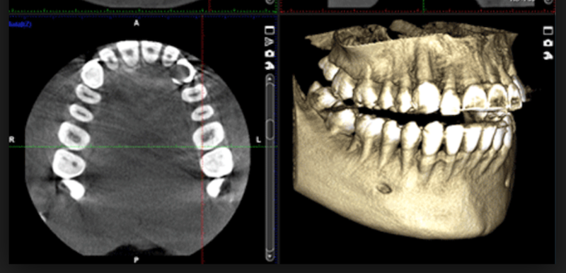 CBCT 3D
