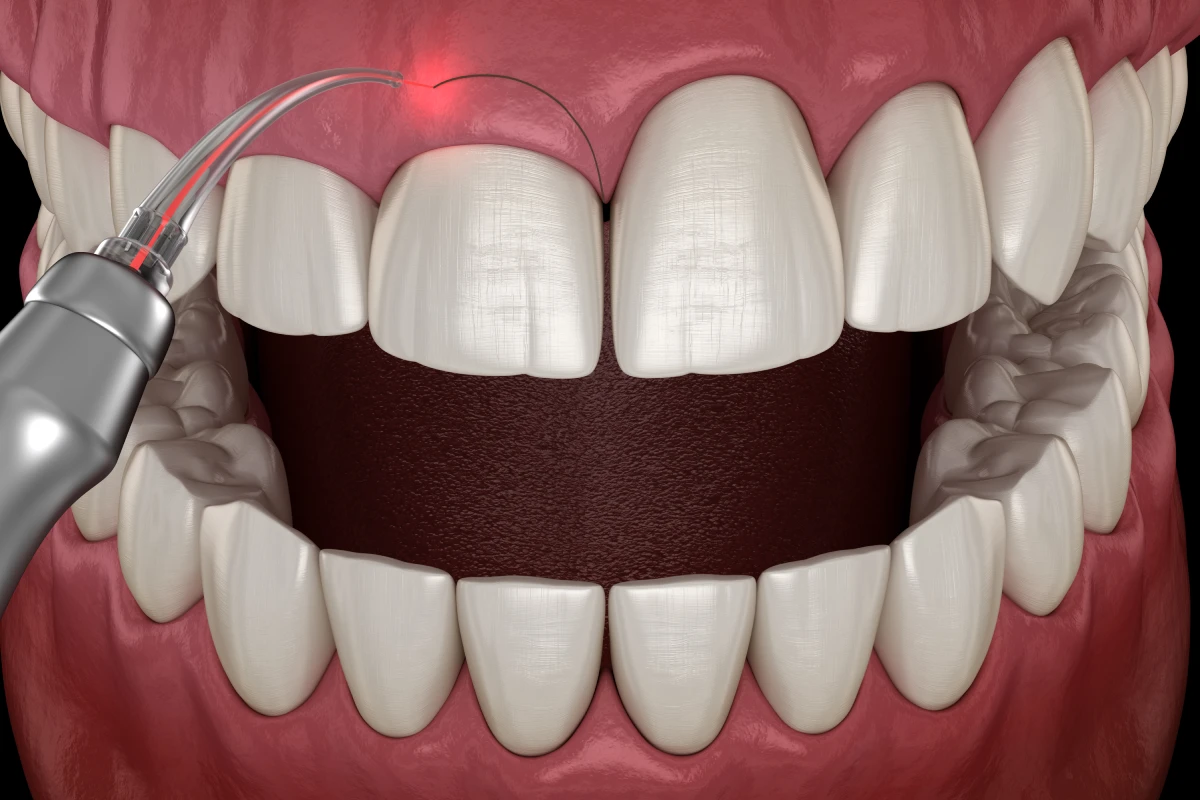 Gingivectomía