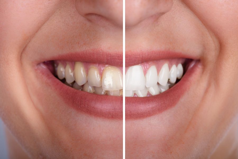 ¿Por qué se me tiñen los dientes?