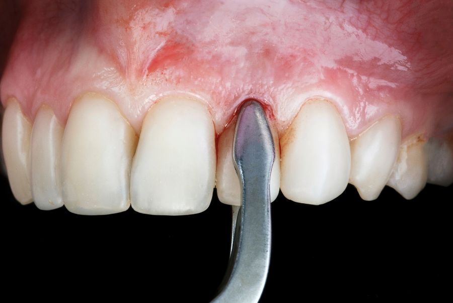 ¿Qué hacer después de una extracción dental?