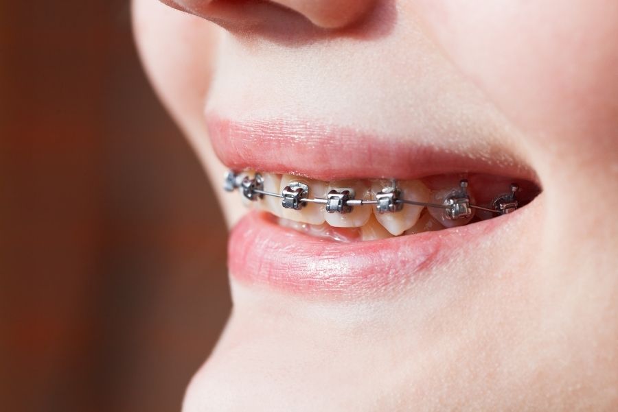 ¿Qué son los brackets autoligado?