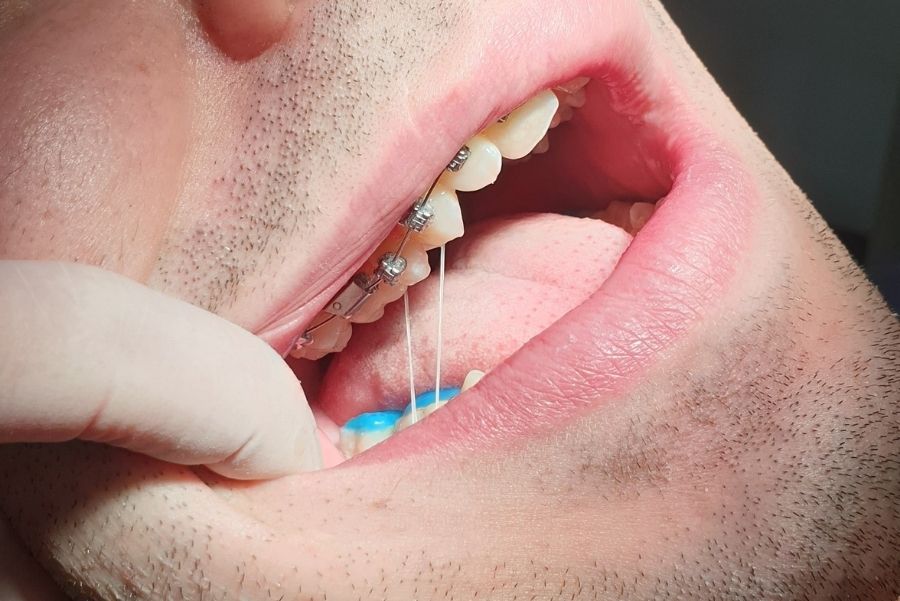 Importancia del uso de elásticos intermaxilares