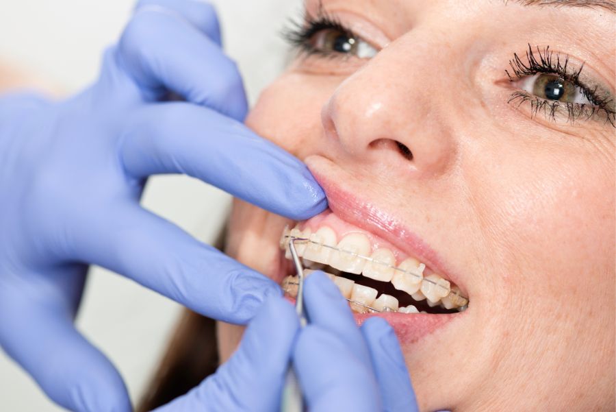 ¿Cómo evitar que se despeguen los brackets?