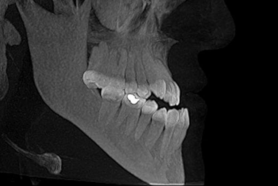 Tratamiento de Ortodoncia con Cirugia Ortognática