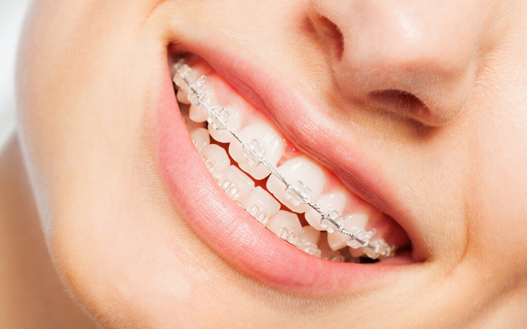 ¿Existen los brackets invisibles?