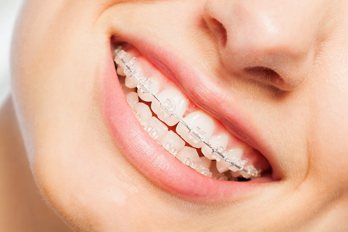 ¿Existen los brackets invisibles?