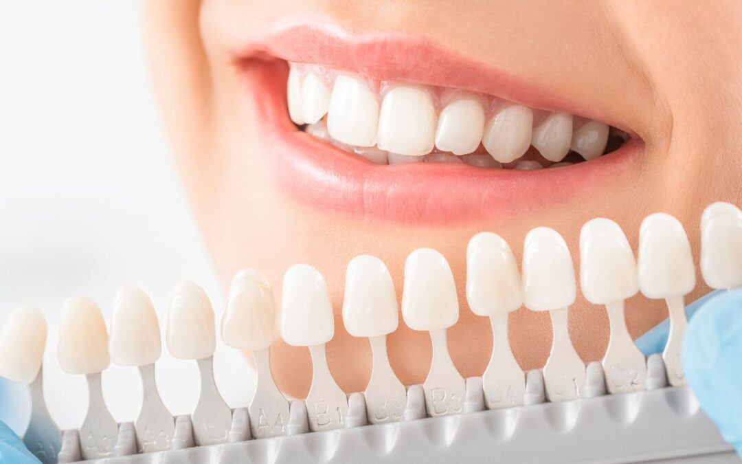 Opiniones profesionales sobre el blanqueamiento dental