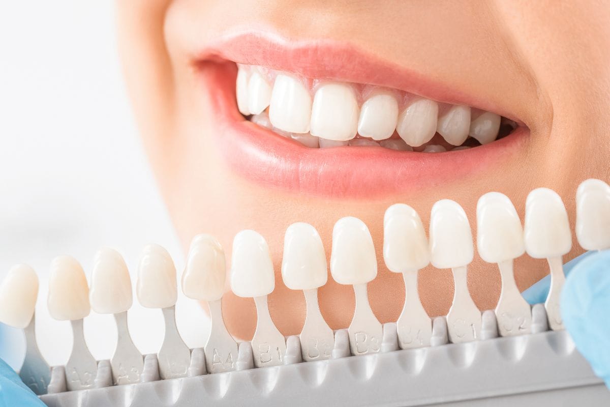 blanqueamiento-dental