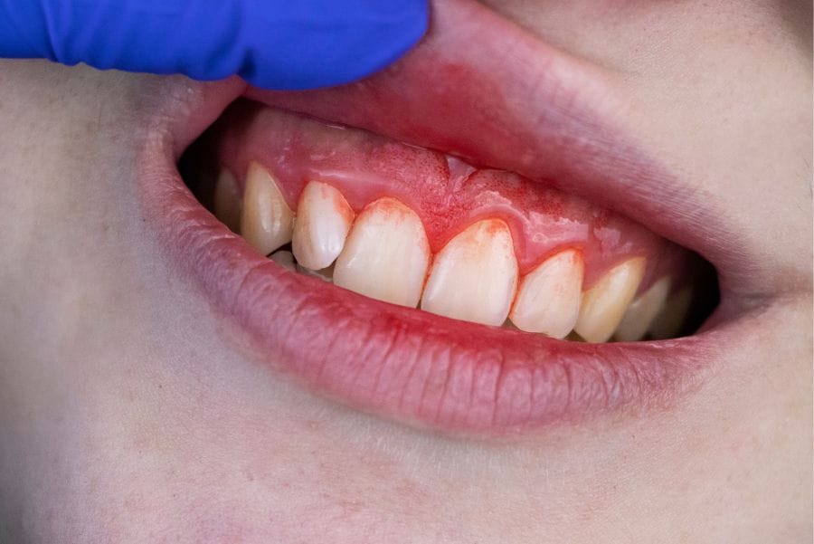 enfermedad periodontal durante la adolescencia