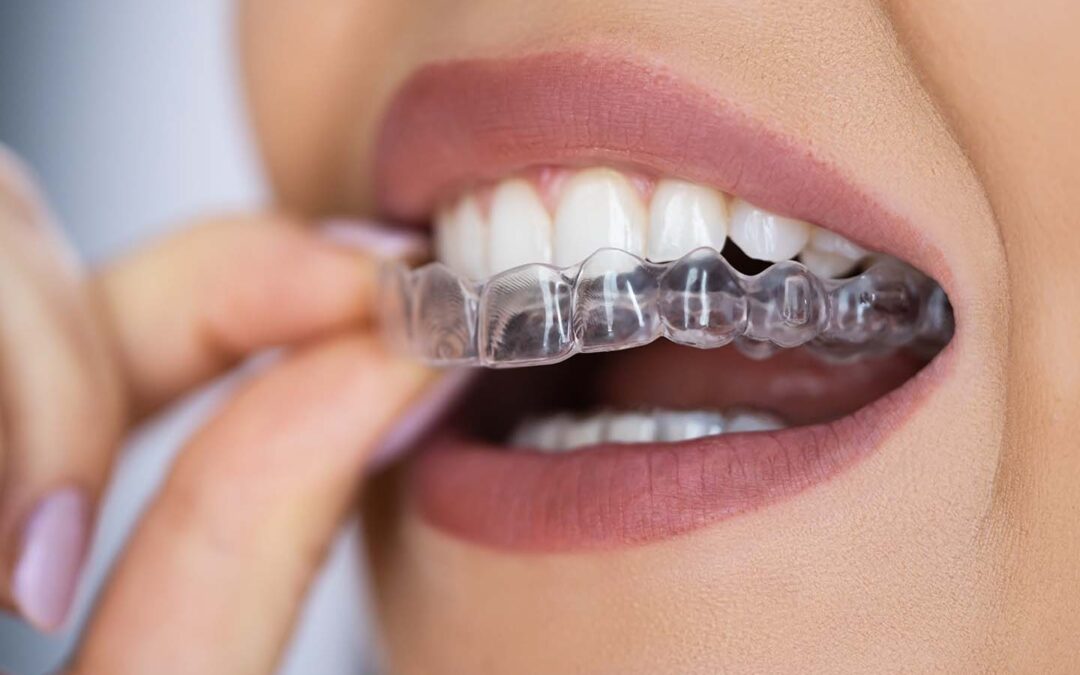 ¿Cuánto dura el tratamiento de ortodoncia invisible?