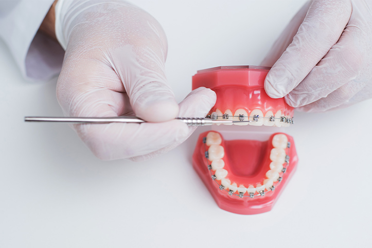 ¿Se pueden alinear los dientes sin brackets?