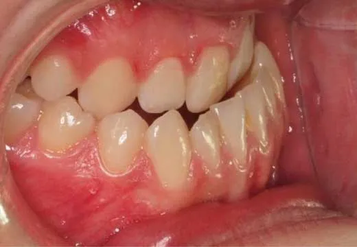 antes-dientes-sara-1