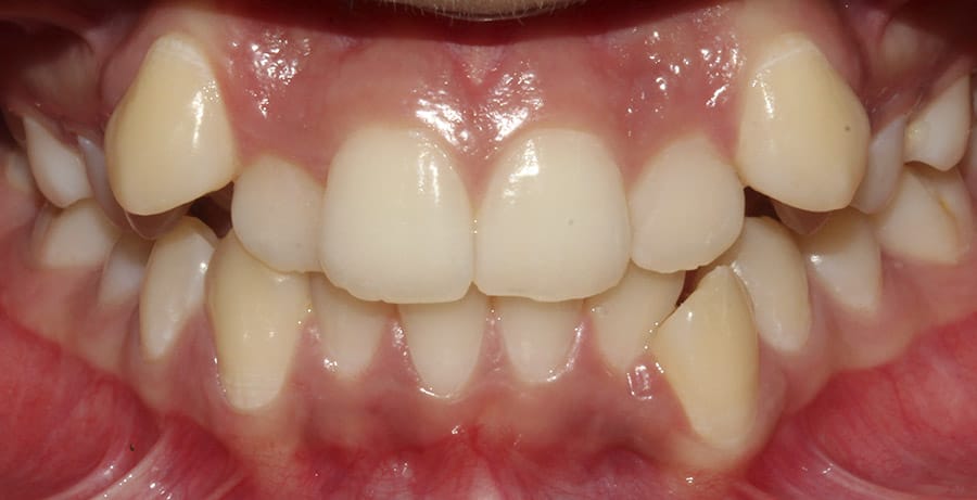 Apiñamiento dental caso real