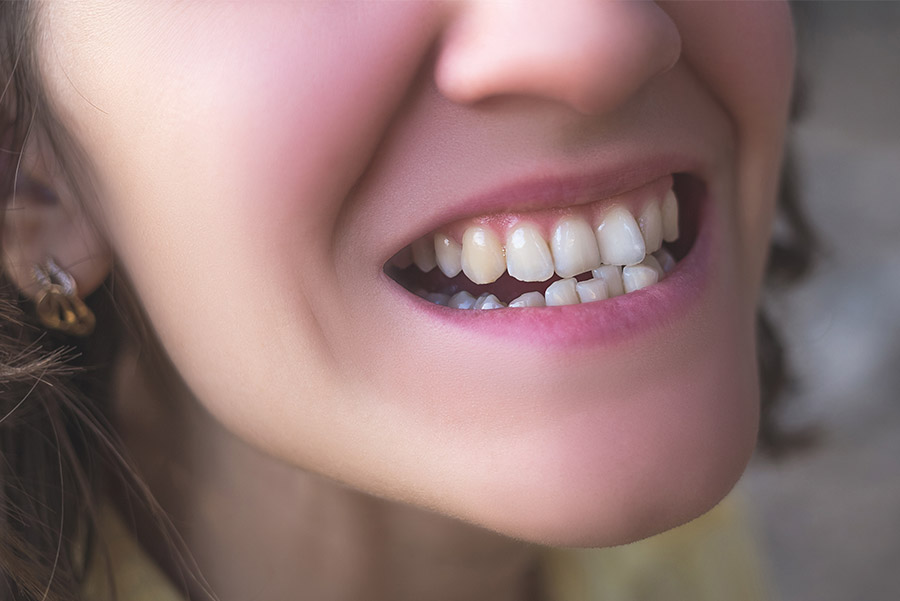 Qué es el apiñamiento dental y cómo solucionarlo