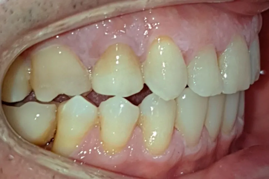 arcada-lateral-drcha-despues