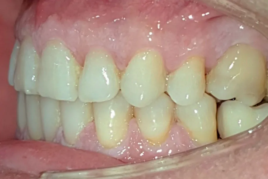 arcada-lateral-izq-despues