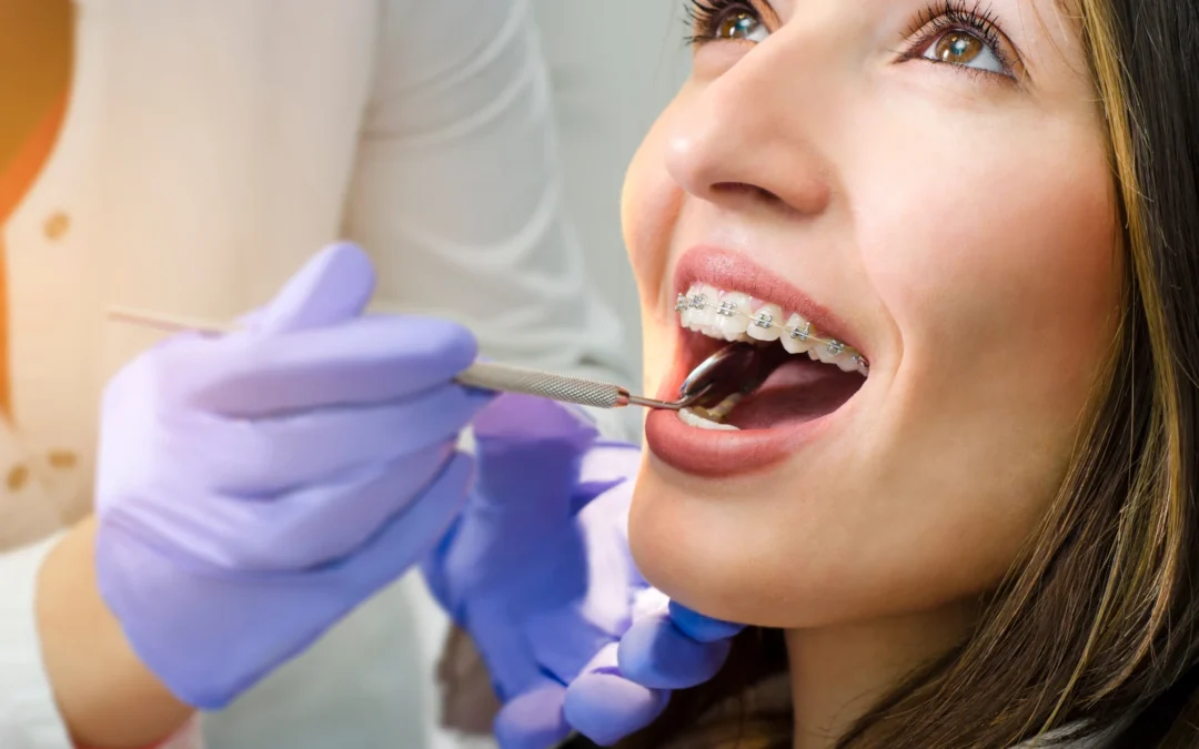 ¿Qué tipos de brackets de autoligado existen?