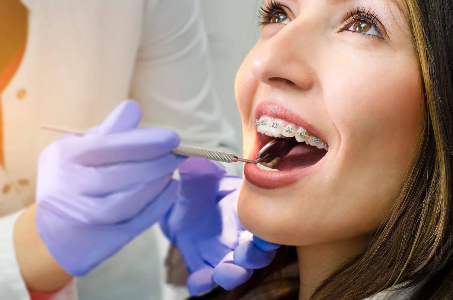 ¿Qué tipos de brackets de autoligado existen?