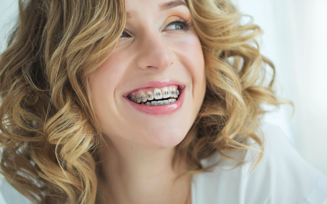 ¿Qué es mejor, brackets convencionales o de autoligado?