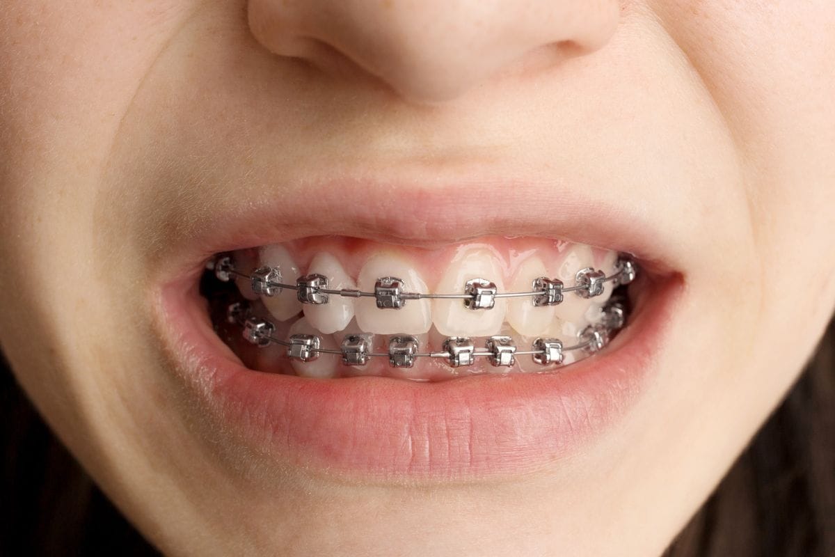 brackets-autoligado