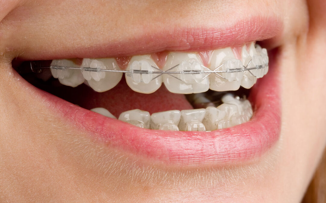 ¿Cómo se llaman los brackets blancos?