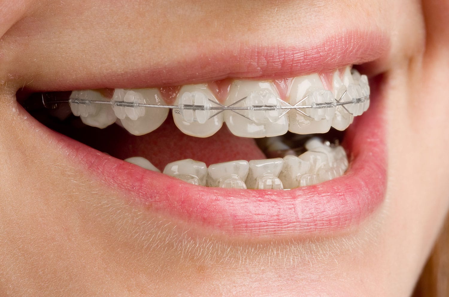 brackets-blancos-transparentes