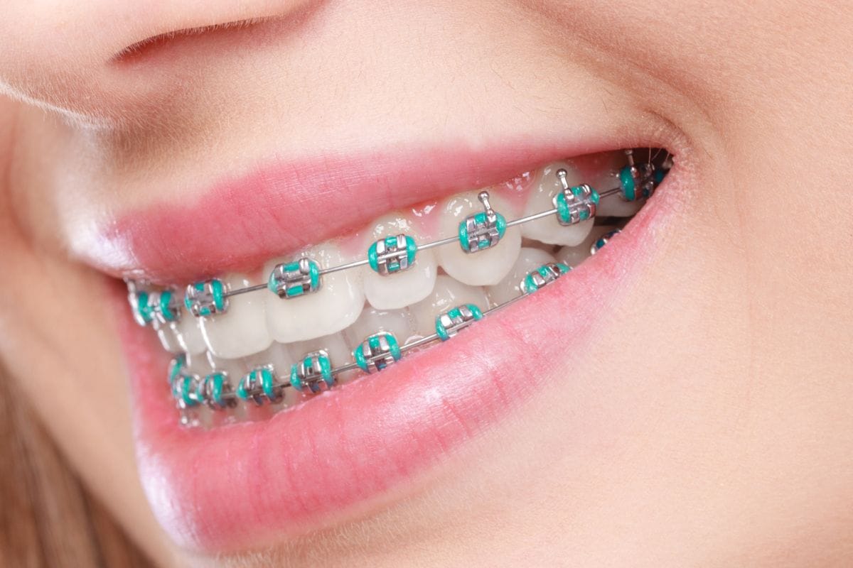 brackets-convencionales
