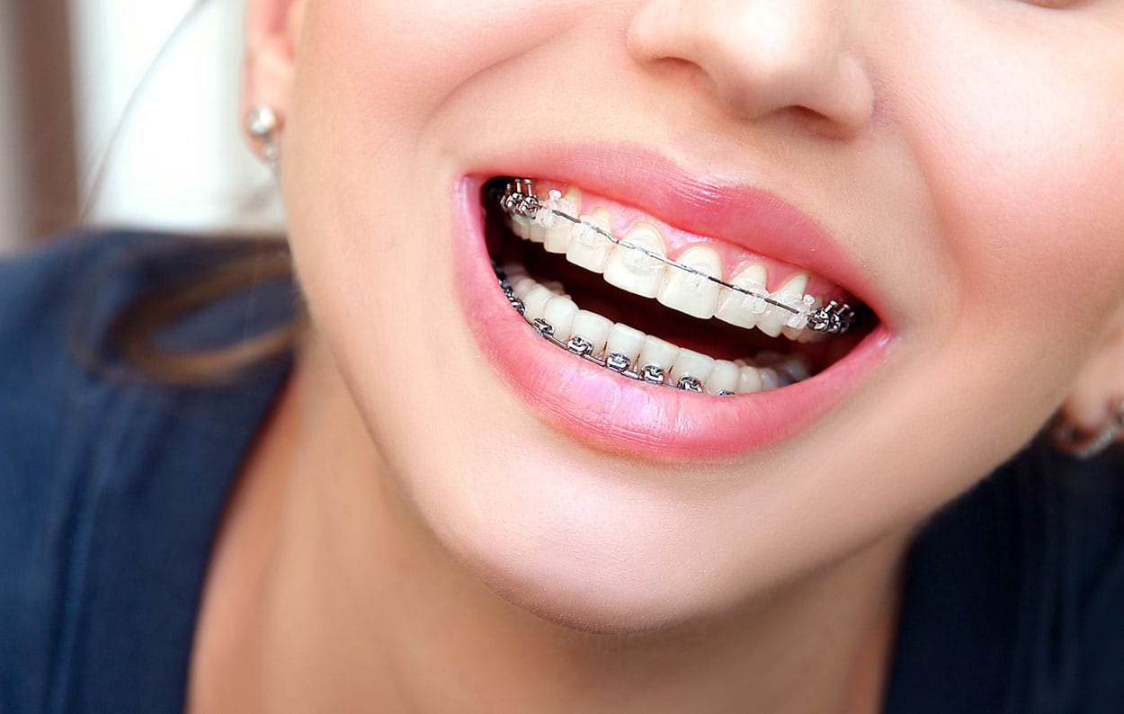 brackets-tradicionales-y-brackets-transparentes