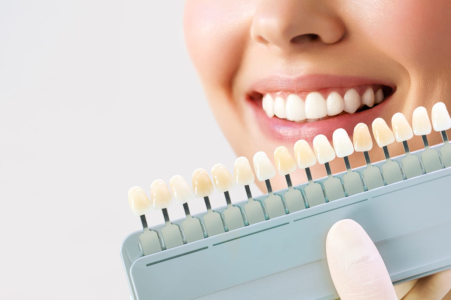 carillas-dentales