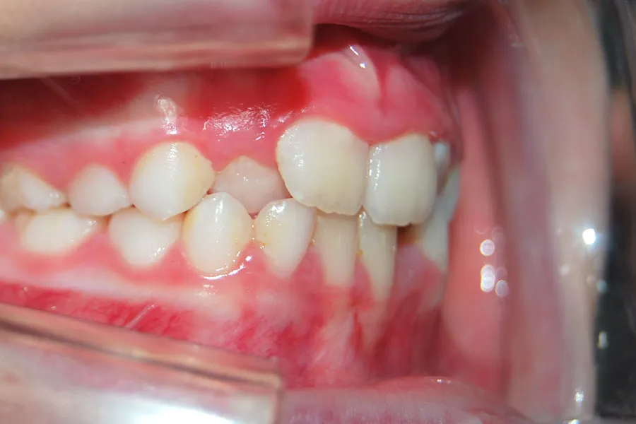 caso-clinico-andrea-lateral-drcho-antes