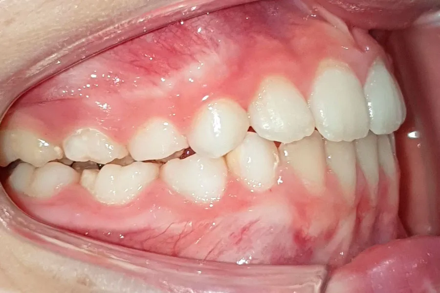 caso-clinico-andrea-lateral-drcho-despues