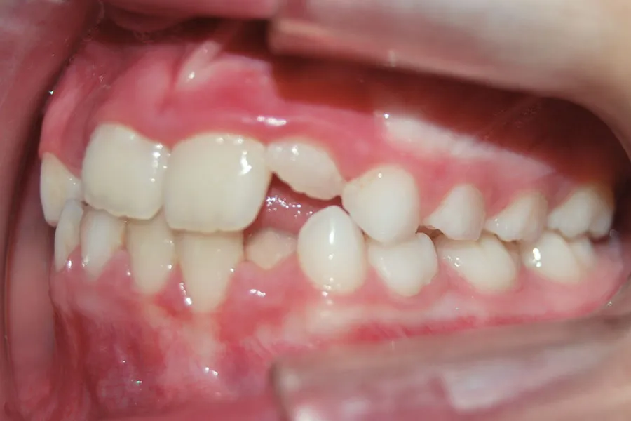 caso-clinico-andrea-lateral-izq-antes