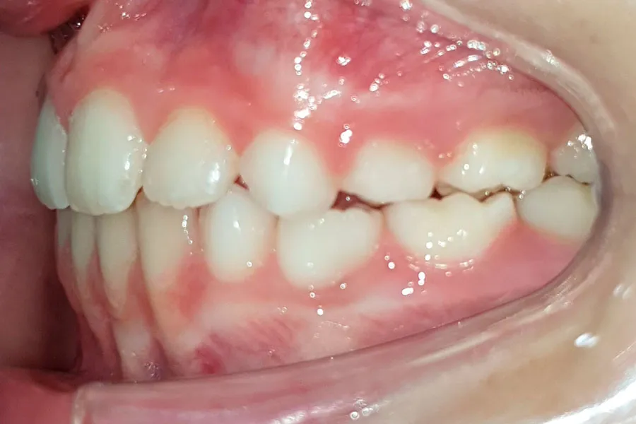 caso-clinico-andrea-lateral-izq-despues