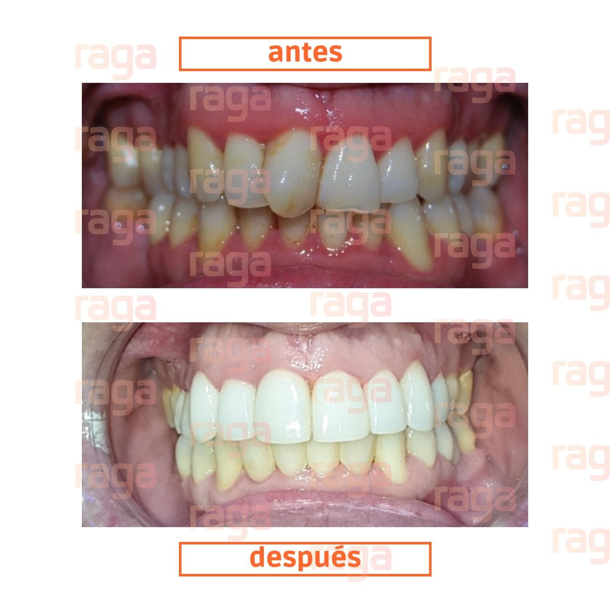 caso-clínico-carillas-dentales